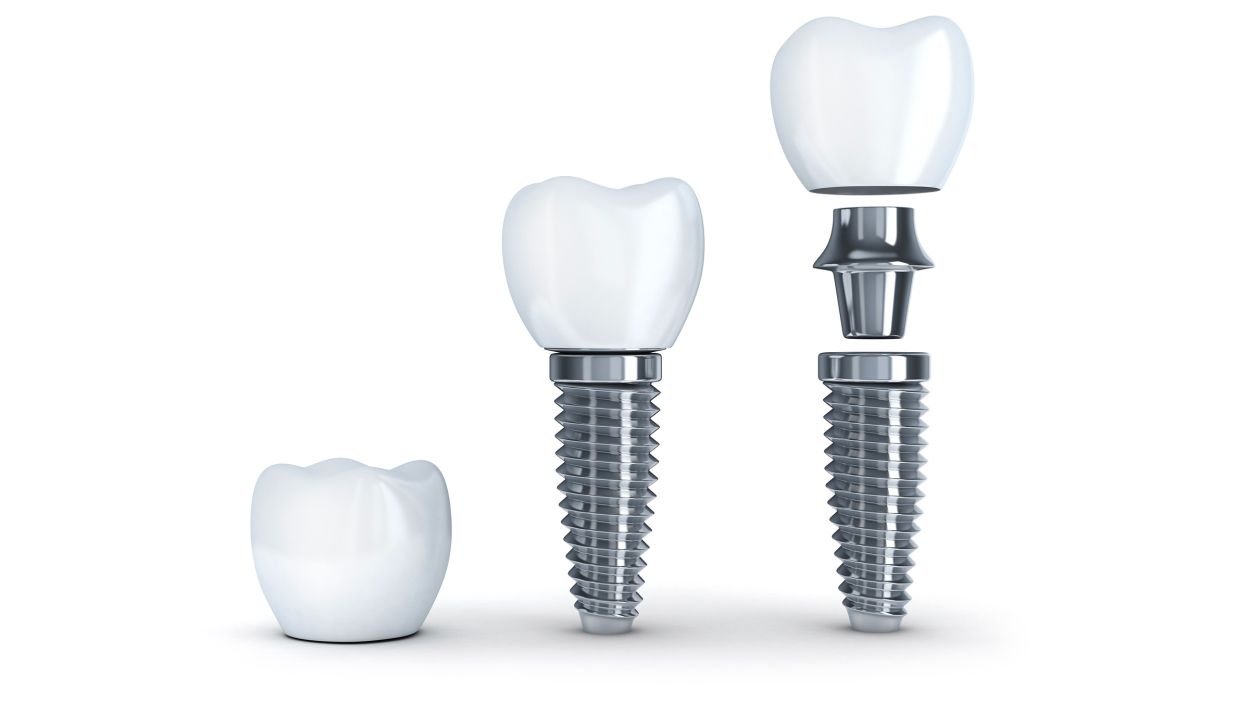Dental Implants at Sherwood Dental Care