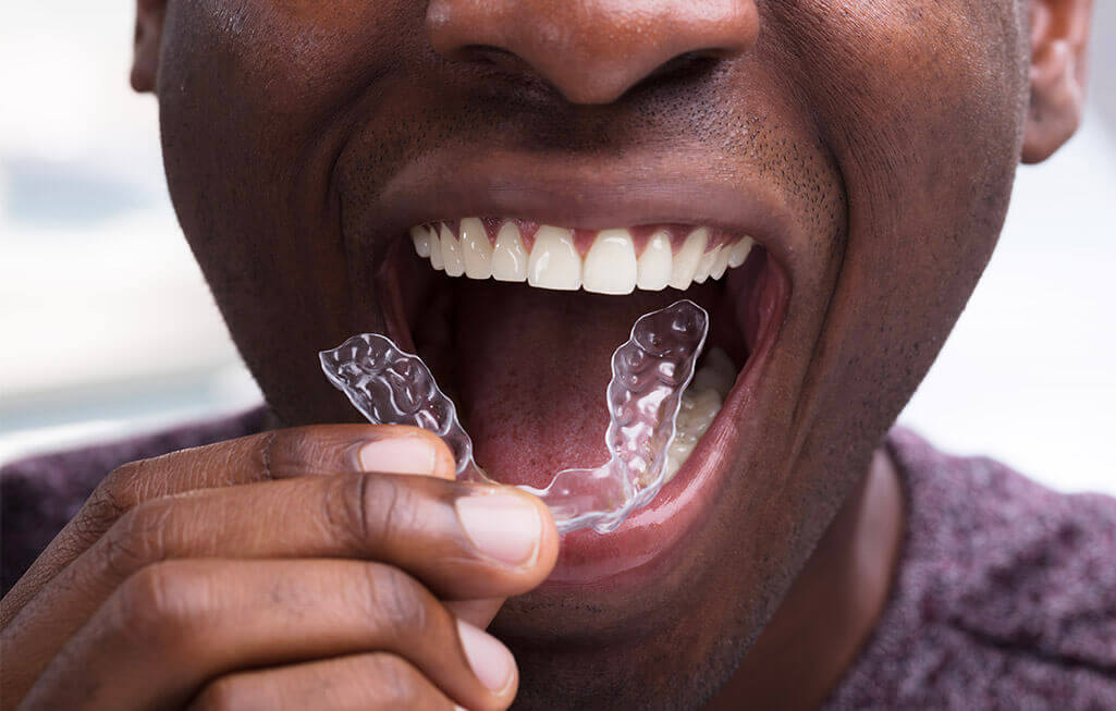 Invisalign Nottingham Clear Braces Sherwood Dental Care